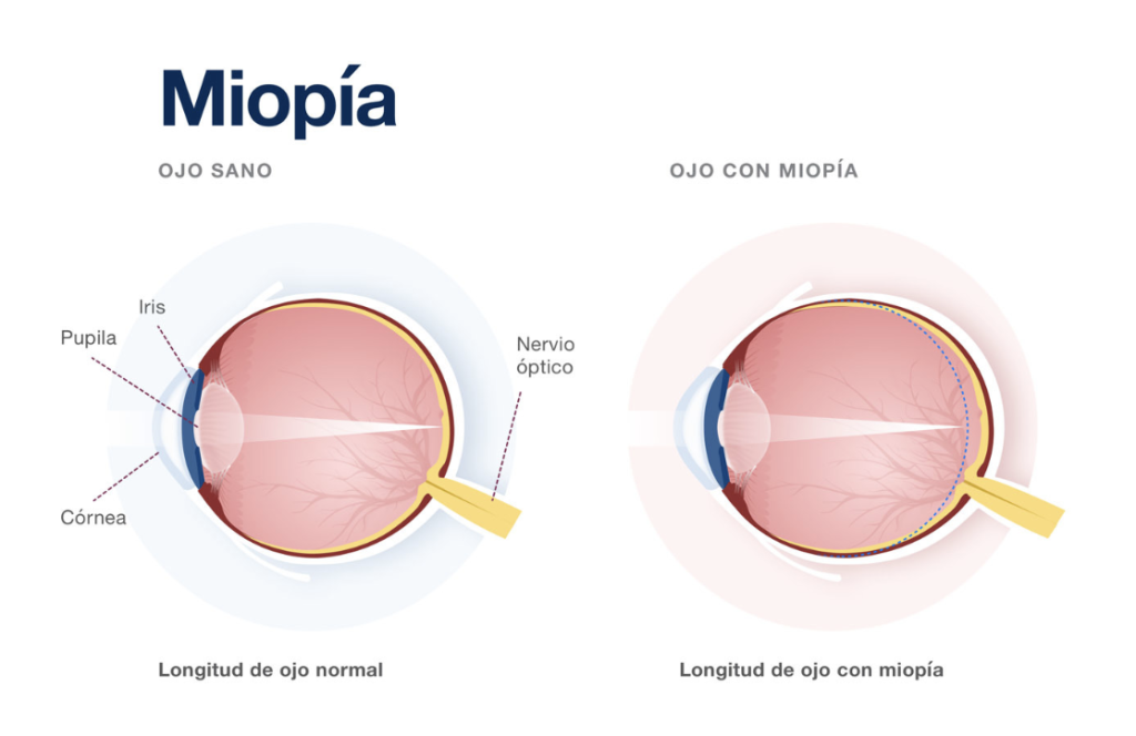 miopia-bermeo-optika